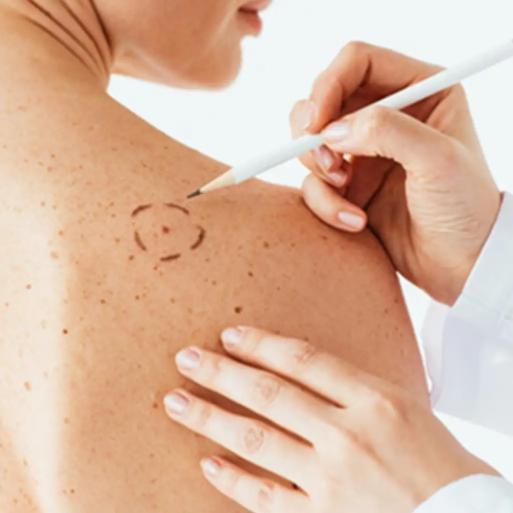 Photo of a persons back with Dr looking for skin cancer